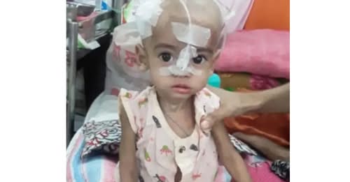 রূপগঞ্জে হামে আক্রান্ত দুই শিশুর মৃত্যু, এলাকায় আতঙ্ক
